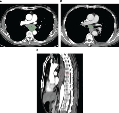 A computed tomography-based nomogram for neoadjuvant chemotherapy plus immunotherapy response prediction in patients with advanced esophageal squamous cell carcinoma